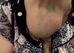 Полутораметровую опухоль удалили врачи у пациентки в Сочи