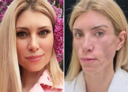 Изуродованная модель из Сочи выиграла у клиники 6,5 миллионов за неудачную операцию