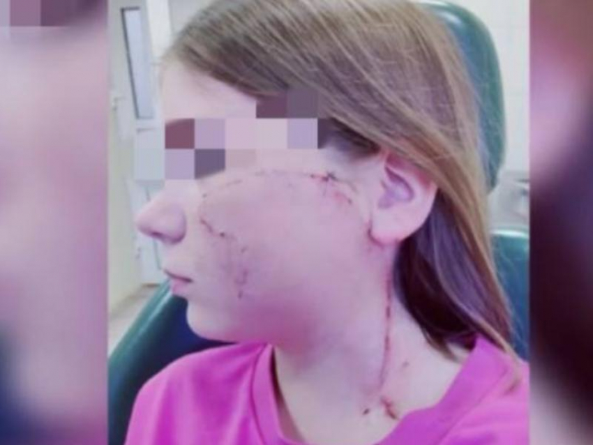 Юной жительнице Сочи провели сложную операцию по восстановлению щеки после нападения собаки